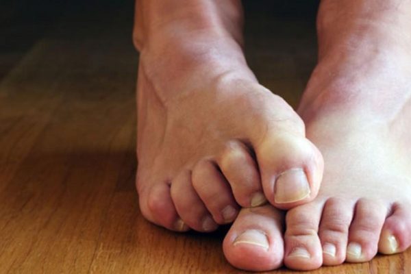 5 Cara Mengidentifikasi dan Mengatasi Gejala Penyakit Kaki 5 Cara Mengidentifikasi dan Mengatasi Gejala Penyakit Kaki