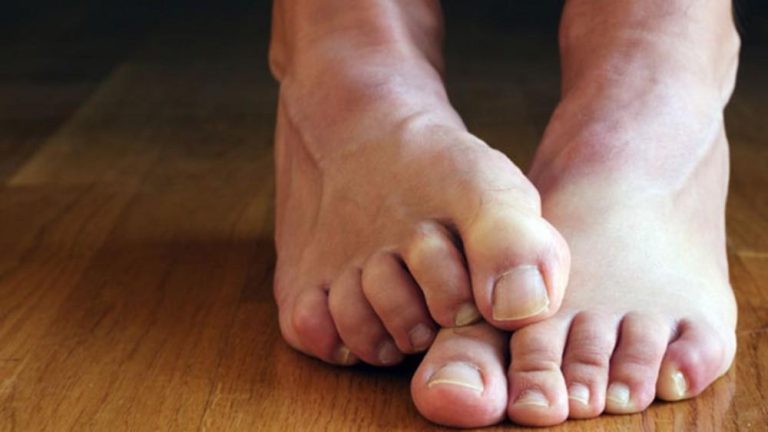 5 Cara Mengidentifikasi dan Mengatasi Gejala Penyakit Kaki