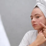 5 Cara Mengatasi Jerawat Batu dengan Efektif