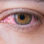 7 Cara Efektif Mengatasi Iritasi Mata Akibat Alergi