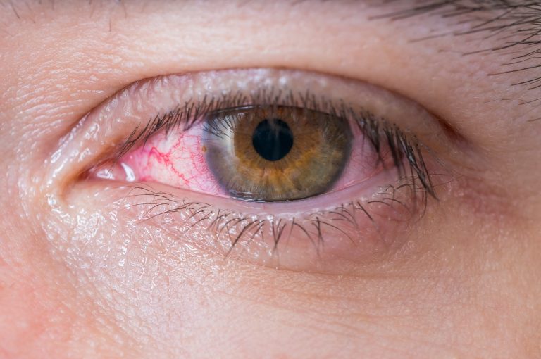 7 Cara Efektif Mengatasi Iritasi Mata Akibat Alergi