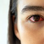 7 Langkah-langkah Menghadapi Mata Merah dan Iritasi