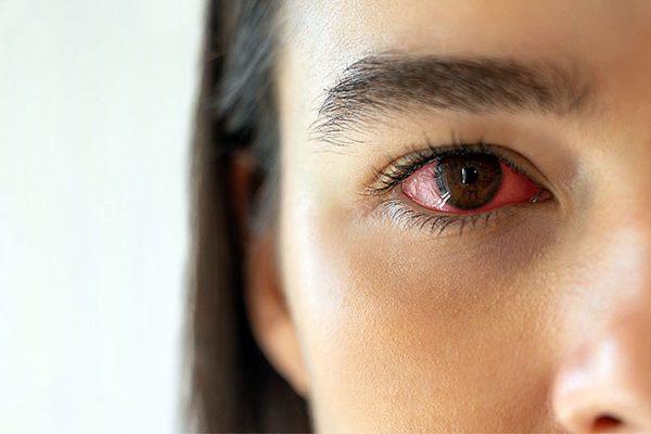 7 Langkah-langkah Menghadapi Mata Merah dan Iritasi