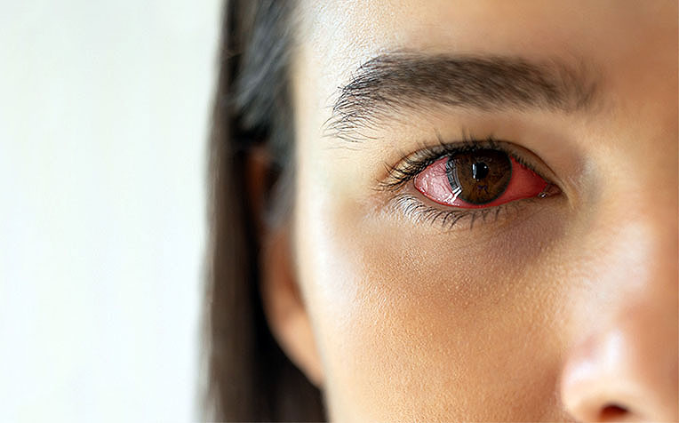 7 Langkah-langkah Menghadapi Mata Merah dan Iritasi