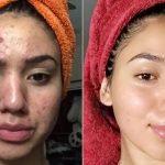 5 Tips Merawat Kulit Remaja agar Terhindar dari Jerawat