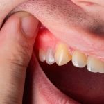 7 Cara Mengatasi Gusi Bengkak Secara Alami
