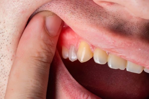 7 Cara Mengatasi Gusi Bengkak Secara Alami 7 Cara Mengatasi Gusi Bengkak Secara Alami