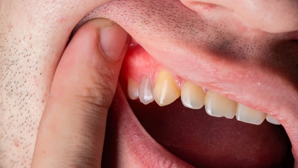 7 Cara Mengatasi Gusi Bengkak Secara Alami