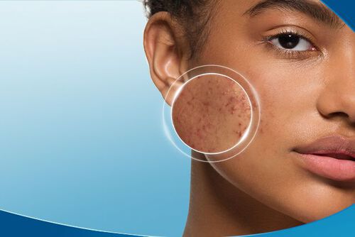 7 Cara Merawat Kulit Sensitif yang Mudah Berjerawat