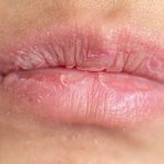 10 Cara Mengatasi Bibir Mengelupas Secara Alami