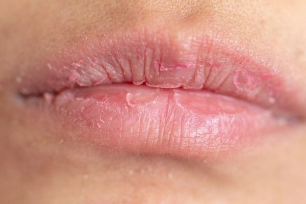 10 Cara Mengatasi Bibir Mengelupas Secara Alami 10 Cara Mengatasi Bibir Mengelupas Secara Alami