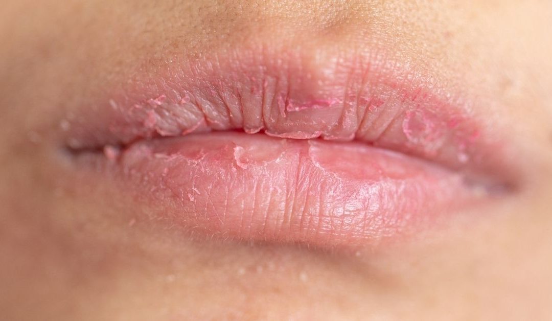 10 Cara Mengatasi Bibir Mengelupas Secara Alami