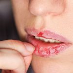 10 Tips Merawat Bibir Setelah Sakit Demam