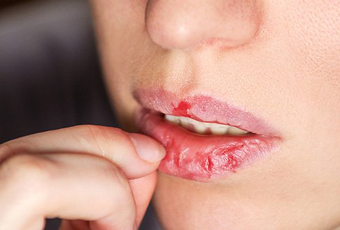 10 Tips Merawat Bibir Setelah Sakit Demam 10 Tips Merawat Bibir Setelah Sakit Demam