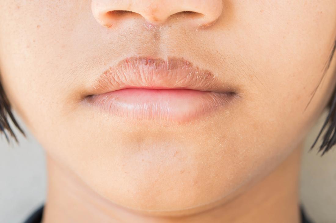 10 Cara Mengatasi Bibir Terlalu Kering Saat Flu
