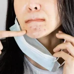 5 Cara Mengatasi Iritasi Dagu Akibat Pemakaian Masker Berlebih
