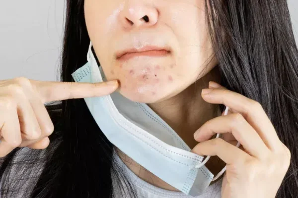 5 Cara Mengatasi Iritasi Dagu Akibat Pemakaian Masker Berlebih