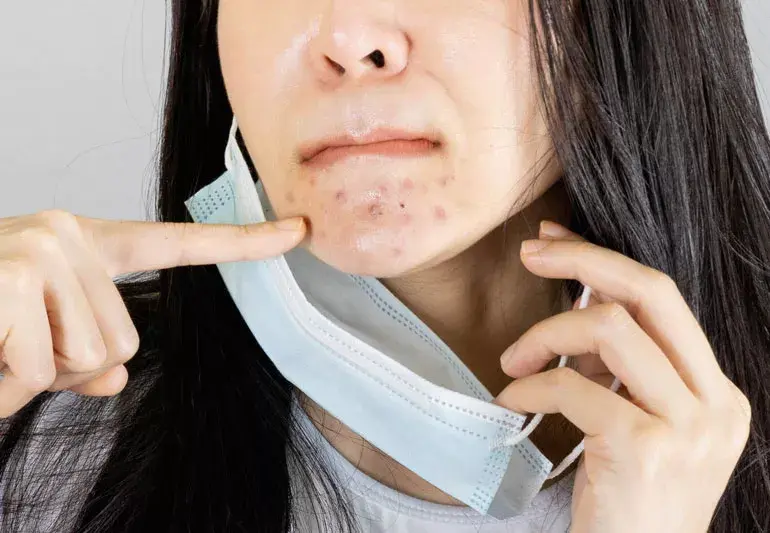 5 Cara Mengatasi Iritasi Dagu Akibat Pemakaian Masker Berlebih