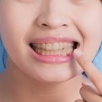 10 Cara Mengatasi Gigi Kuning tanpa Ke Dokter