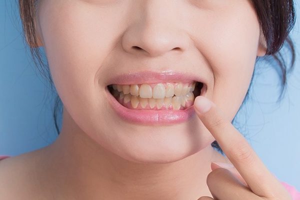 10 Cara Mengatasi Gigi Kuning tanpa Ke Dokter 10 Cara Mengatasi Gigi Kuning tanpa Ke Dokter