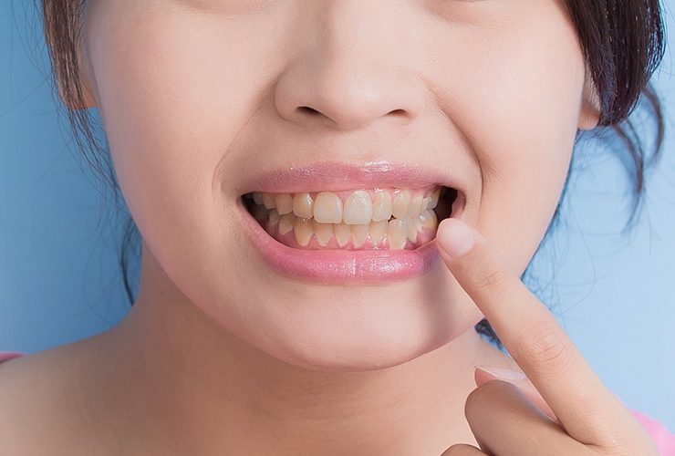 10 Cara Mengatasi Gigi Kuning tanpa Ke Dokter